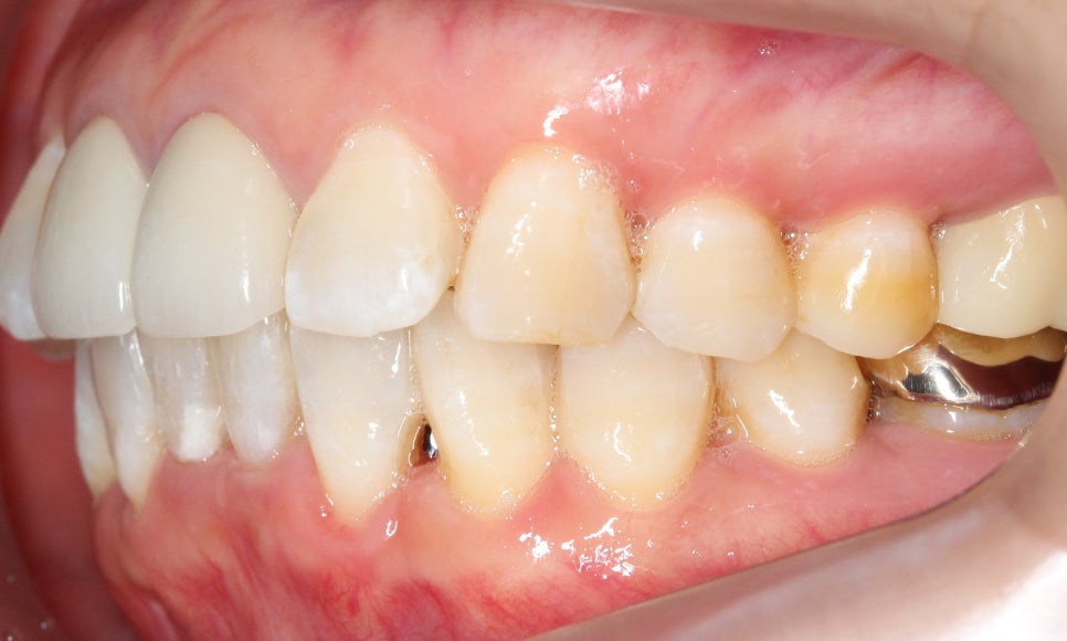 2D교정으로 아랫니 부분교정 빠르게 완성하기! 관련 이미지 9