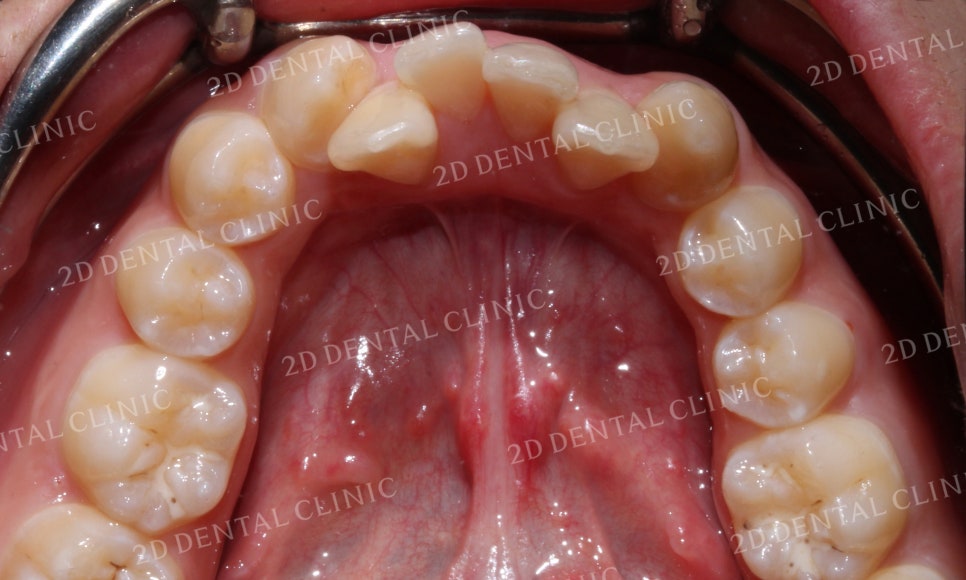 돌출앞니 교정, 튀어나온 입을 넣어보자! by.투디치과(2D치과) 관련 이미지 10