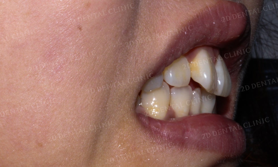 [2D교정] 나비치아, 앞니교정 설측교정으로 빠르게 하는 방법! by.2D치과(투디치과) 관련 이미지 11