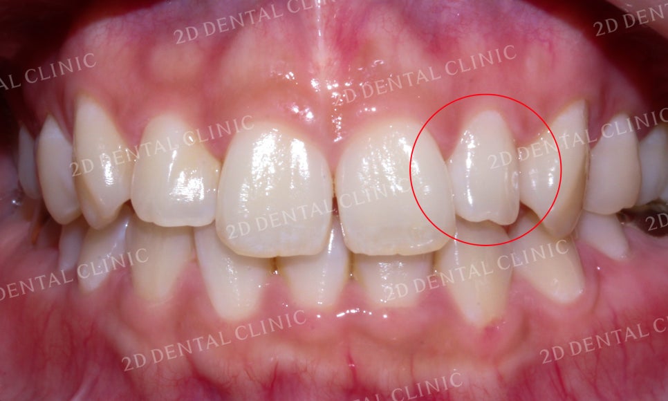 나비치아교정, 부분교정으로 나비치아 탈출하기! by.투디치과(2D치과) 관련 이미지 14