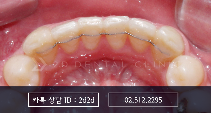 교정 유지 장치, 선택이 아닌 필수! 강남 2D치과 관련 이미지 6