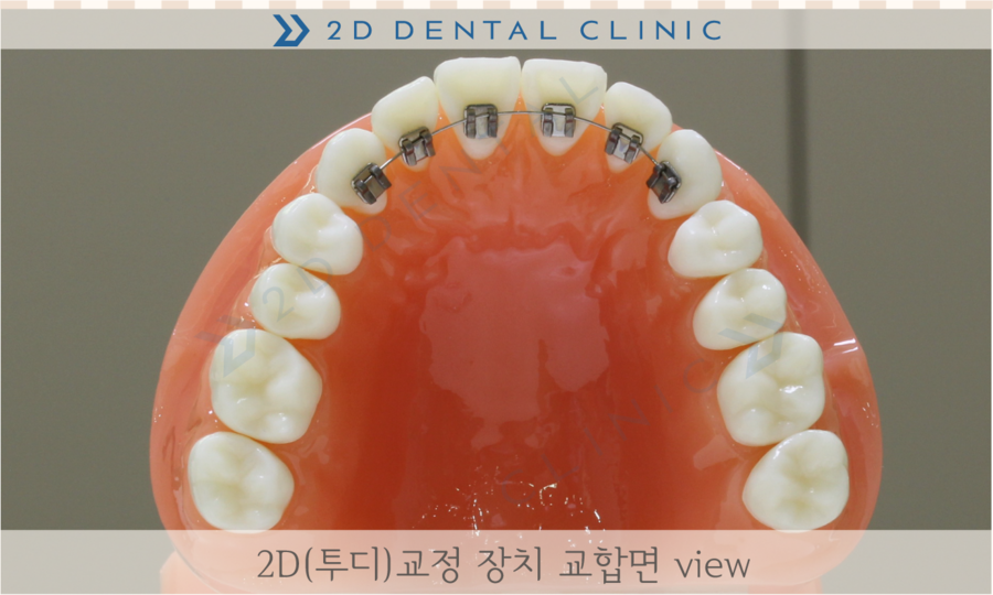 [교정상식] 설측교정,투명교정,콤비교정 장치종류 및 장단점! 관련 이미지 3