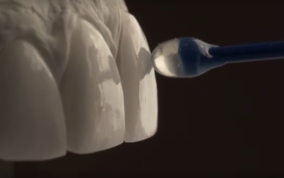 강남라미네이트병원 치아삭제 없는 무삭제치아성형 블랙필름 관련 이미지 3