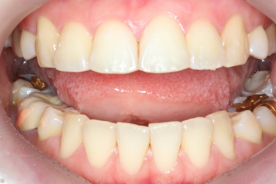 토끼앞니교정 부분교정으로 단기완성 관련 이미지 8