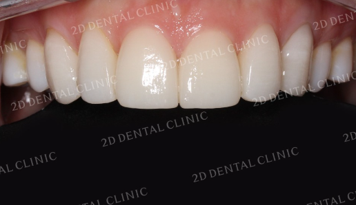 거미스마일 잇몸성형 강남라미네이트 2D치과 관련 이미지 5