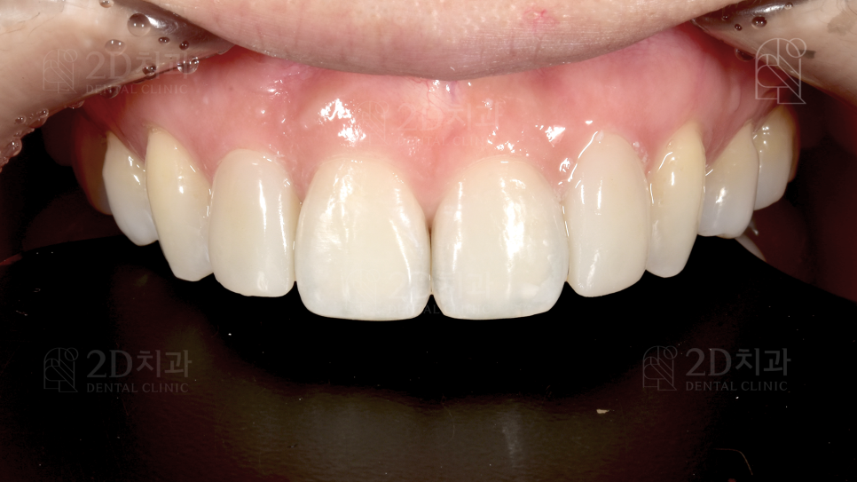 왜소치 라미네이트  신논현역 2D치과 관련 이미지 4