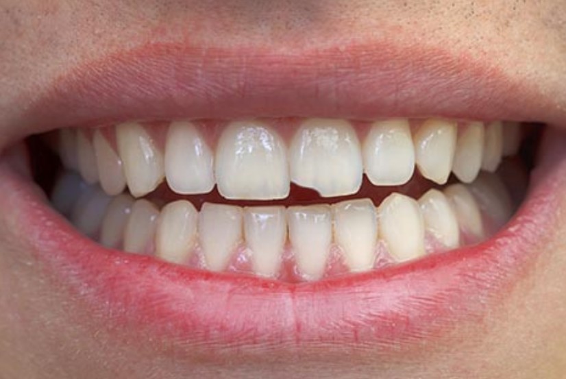 일요일에 문여는 치과  아파죽을것같은데 살려주세요 :: 신논현역 2D치과 관련 이미지 3