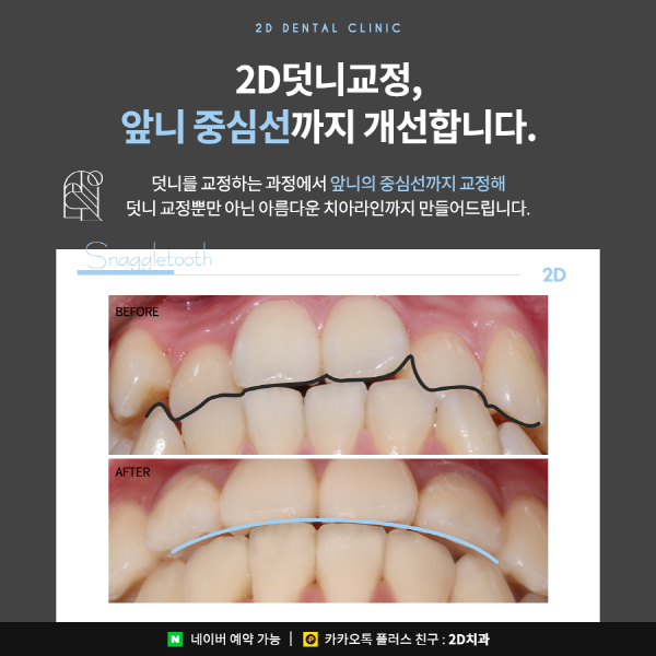 덧니가 두드러져 스트레스일 땐? 2D부분교정 관련 이미지 7