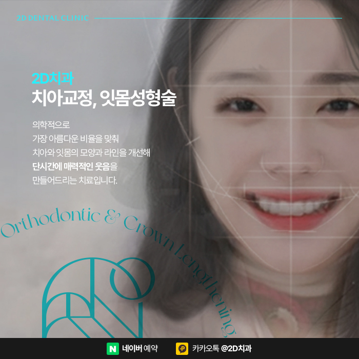 거미스마일 개선을 위한 치아교정, 강남 잇몸성형 관련 이미지 5