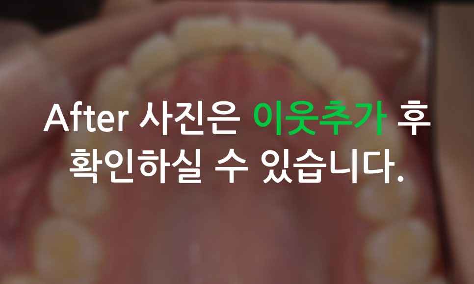 나비앞니 교정, 투디교정으로 빠르게 완성하는 방법! 관련 이미지 7