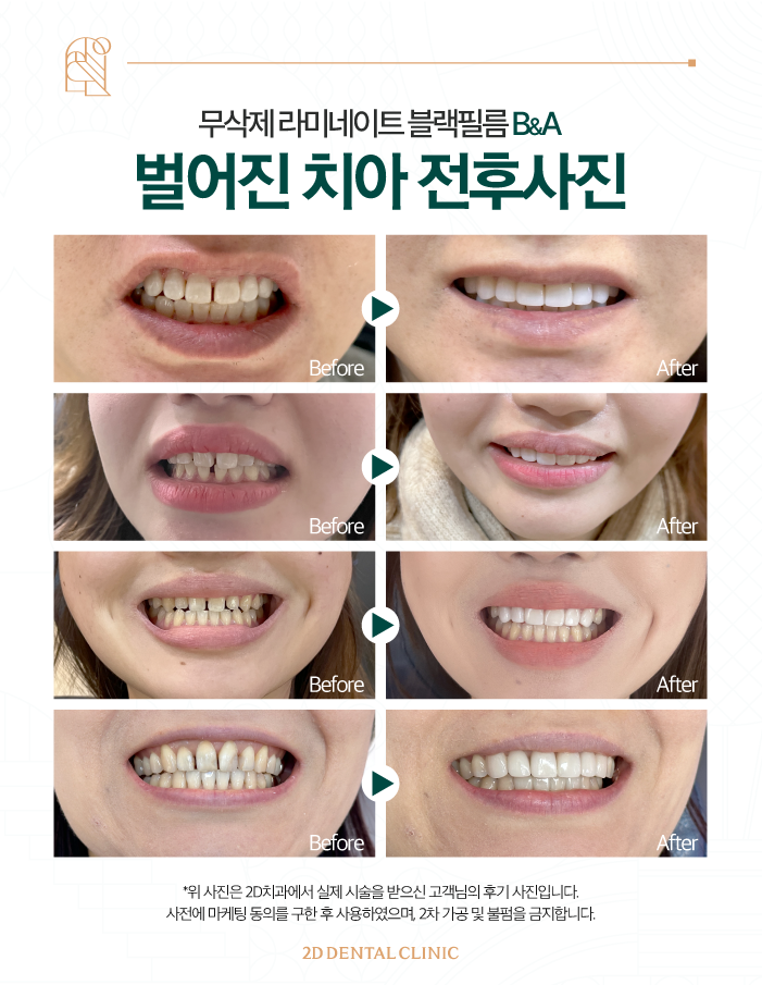 강남무삭제라미네이트 신논현역치과 블랙필름 벌어진 앞니도 걱정 없이! 관련 이미지 7