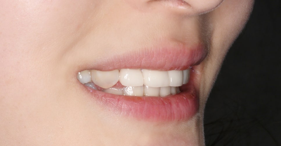 교정일기:앞니 부분 블링스(라미네이트) 심리보철 진료과정 후기 관련 이미지 7