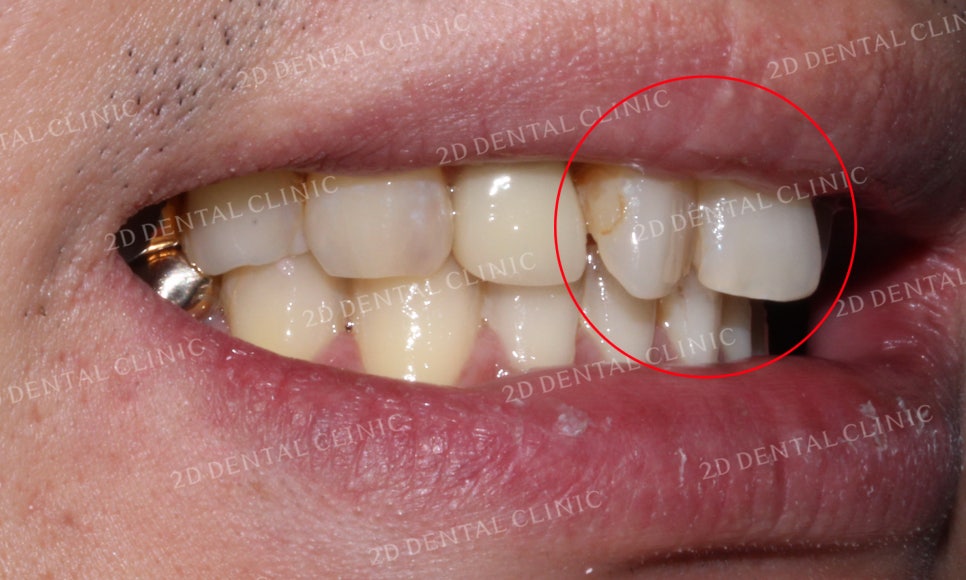 [2D교정] 나비치아교정을 2D교정 장치로 빠르게 완성하기! by.2D치과(투디치과) 관련 이미지 4