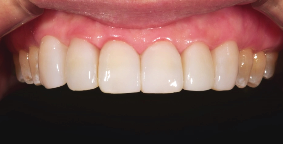 연예인라미네이트 블랙필름 무삭제라미네이트가격 관련 이미지 4