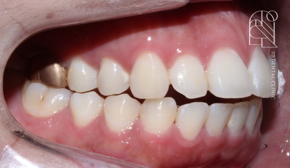 부정교합 치아교정, 전체교정으로 완성하기! by. 투디치과(2D치과) 관련 이미지 4