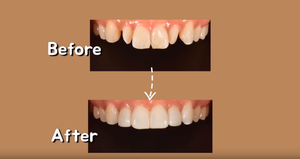 무삭제 라미네이트 쎄라필름, 정말 무삭제? [쎄라필름(TheraFilm)후기_유튜버 Soyeon_pp님] by. 투디치과(2D치과) 관련 이미지 24