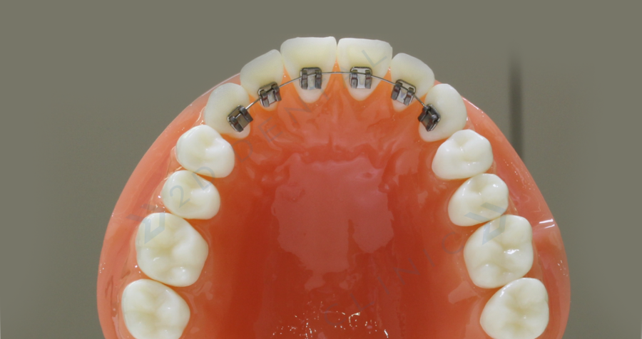 와,앞니 부분교정?!이라고?! 관련 이미지 5