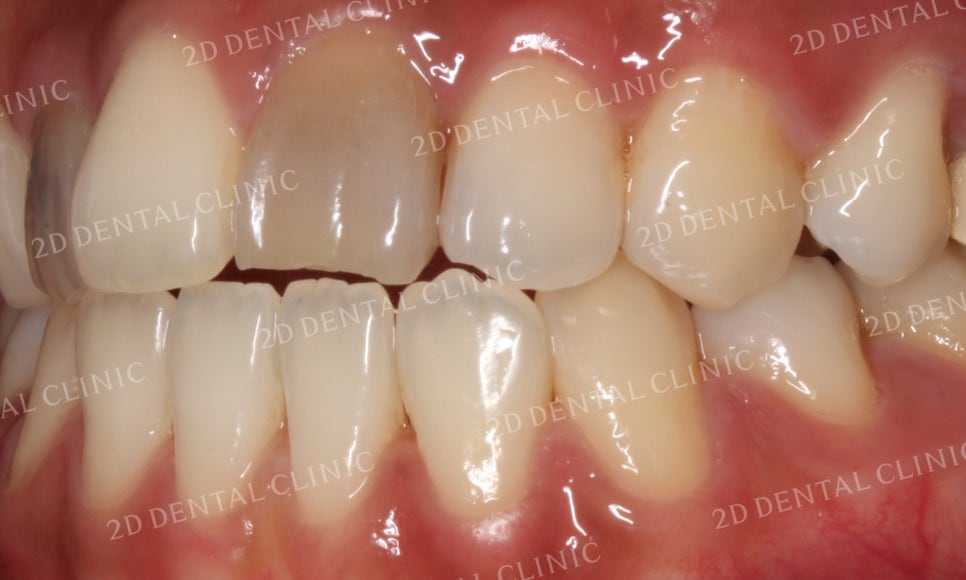 치아변색, 까맣게 변한 변색치를 블링스(Blinx)로 수복하기! by. 투디치과(2D치과) 관련 이미지 4