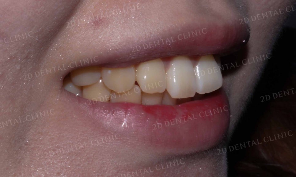강남역 치과에서 앞니부분 설측 2D(투디)교정으로 토끼앞니 탈출한 후기 관련 이미지 12