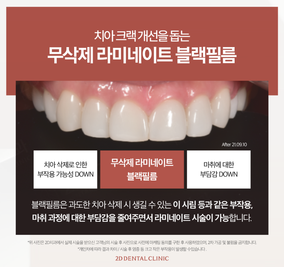 창원무삭제라미네이트 치아균열 이에 생긴 금, 어떻게 해야 할까? 관련 이미지 4