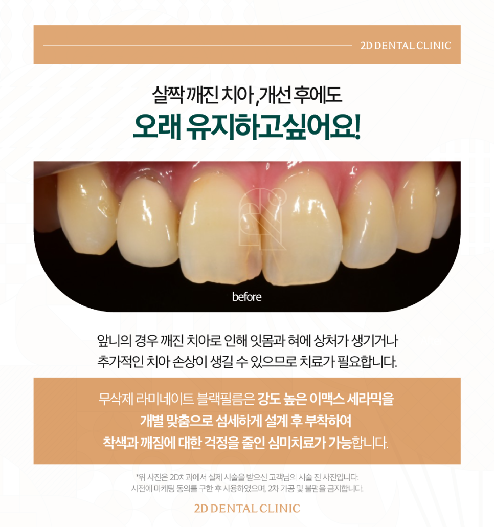 무삭제라미네이트후기 치아살짝깨짐 그대로 두어도 될까요? 관련 이미지 4