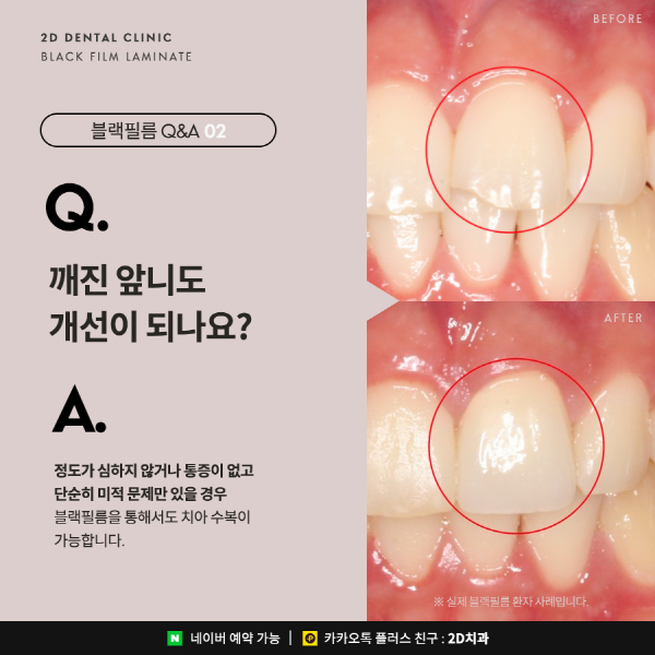 무삭제 라미네이트 <블랙필름> 이 궁금하다면? 관련 이미지 4