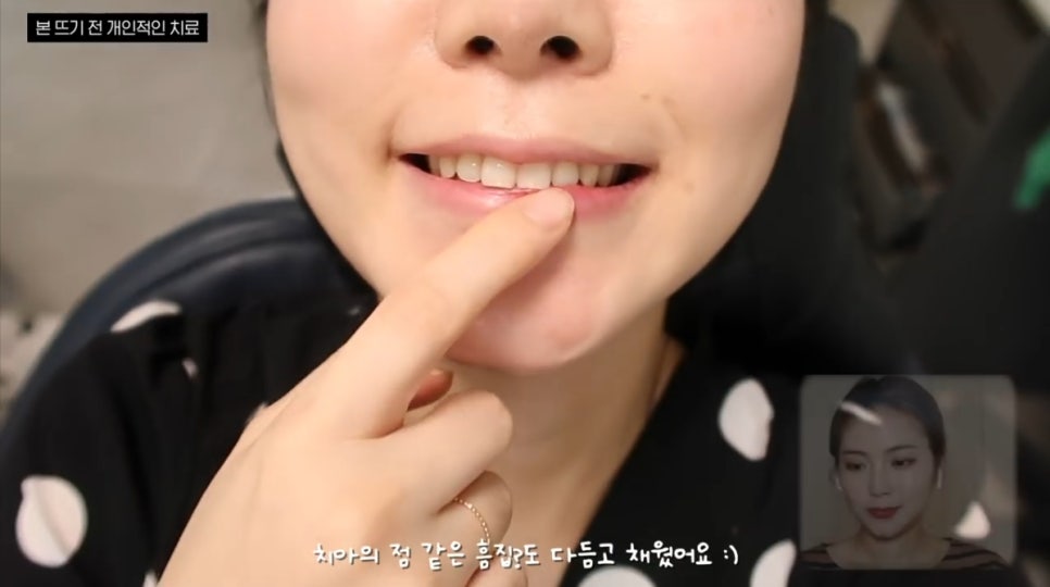 무삭제 라미네이트, 쎄라필름(TheraFilm)후기_유튜버Coco Riley님 by.2D치과(투디치과) 관련 이미지 6