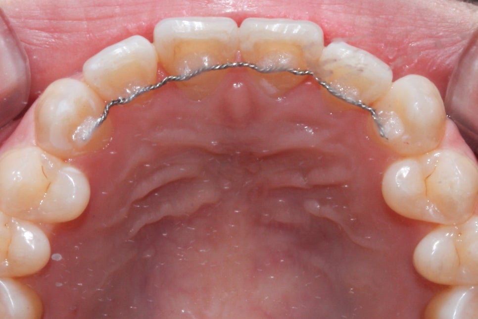 나비치아 교정 케이스 전후비교, 교정전문 2D치과 관련 이미지 6