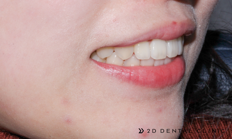 케이스로 확인하는 토끼이빨, 교정전문 2D치과 관련 이미지 6