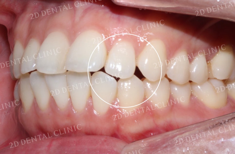 비대칭 앞니, 돌출앞니를 전체 교정으로 교정하고 싶다면!? by.투디치과(2D치과) 관련 이미지 17