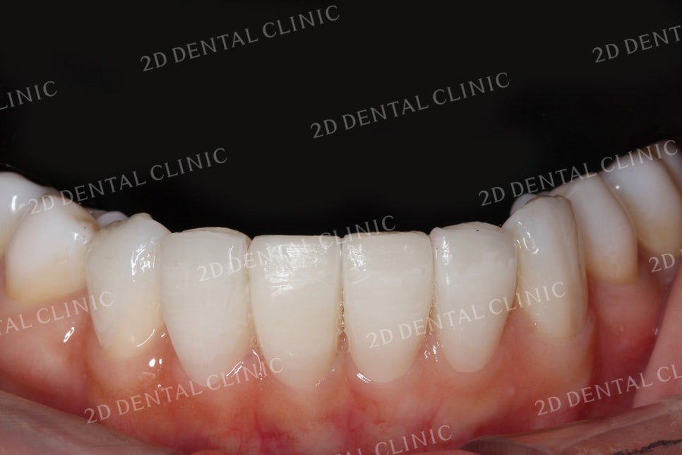 치아틈새를 완벽하게 메꾸자! 블랙트라이앵글 쎄라필름으로 완전 삭제! by.투디치과(2D치과) 관련 이미지 14