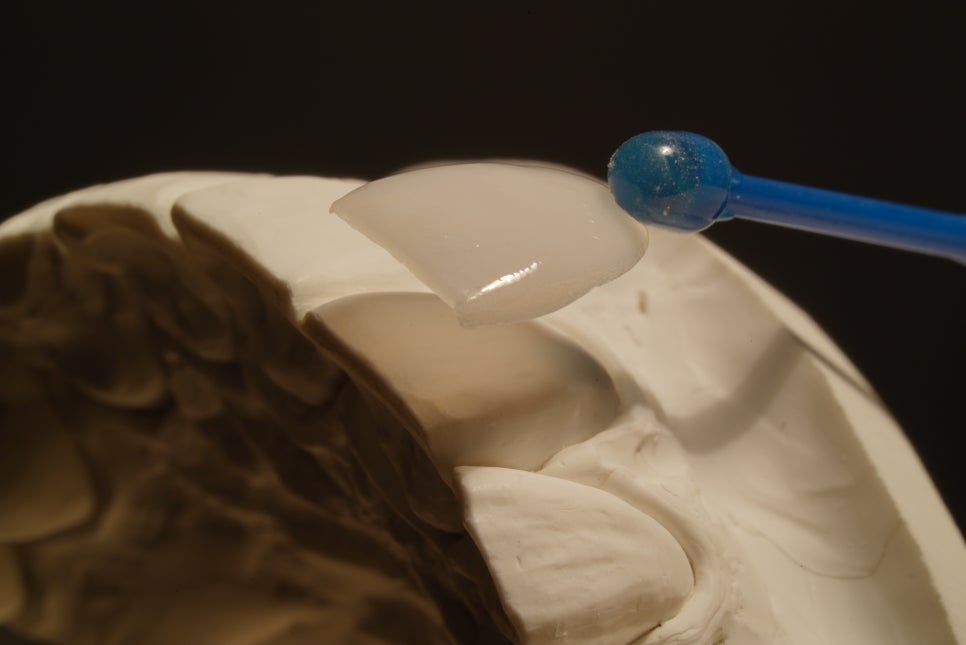 깨진 치아, 벌어진 치아 전부 관련 이미지 2