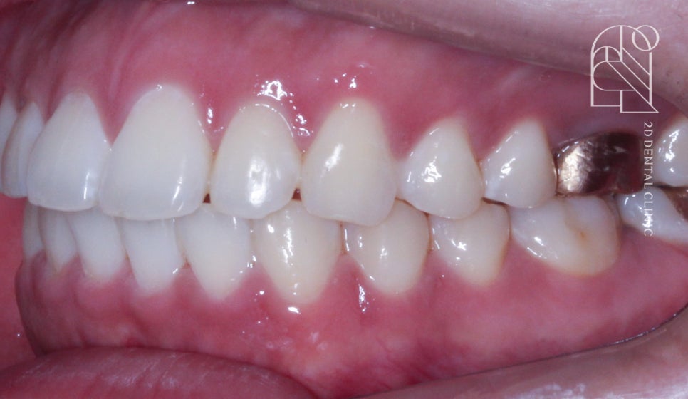 부정교합 치아교정, 전체교정으로 완성하기! by. 투디치과(2D치과) 관련 이미지 13