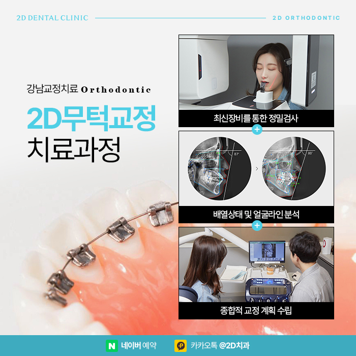 무턱교정으로 얼굴조화의 변화, 강남 교정치과 관련 이미지 5