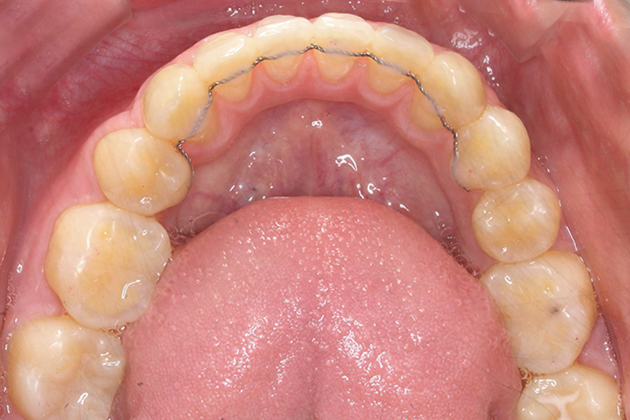 입돌출 데이몬교정 Case1 관련 이미지 15