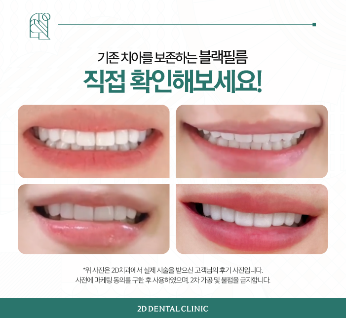 강남역라미네이트 잘하는곳 자연치 그대로 블랙필름 관련 이미지 6