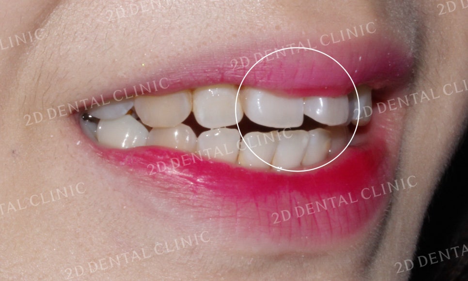 [앞니교정] 부정교합 교정, 앞니교정으로 부정교합 교정하는 방법! by. 투디치과(2D치과) 관련 이미지 4