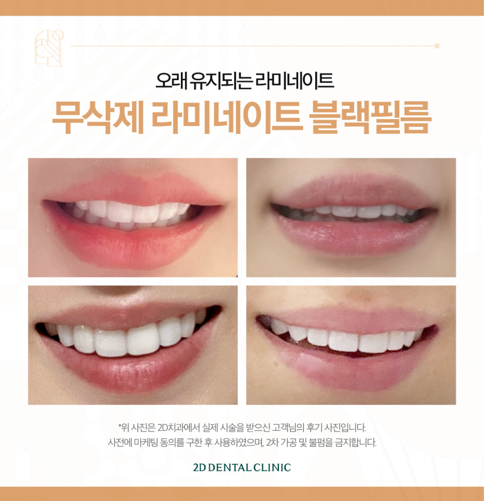 무삭제라미네이트후기 치아깨짐 블랙필름 재시술은? 관련 이미지 8