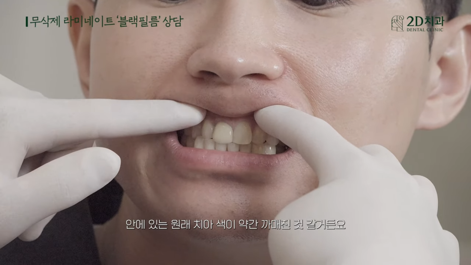 [블랙필름 상담 받고 왔어요] #4 크라운 위에 블랙필름 가능한가요? 관련 이미지 18