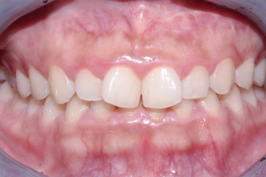 옥니교정 방법! 세라믹교정 Case 관련 이미지 3