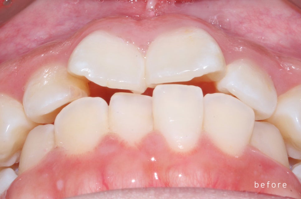 [돌출입 무턱] 안모교정 진행중! by.투디치과(투디치과)전체교정 관련 이미지 5