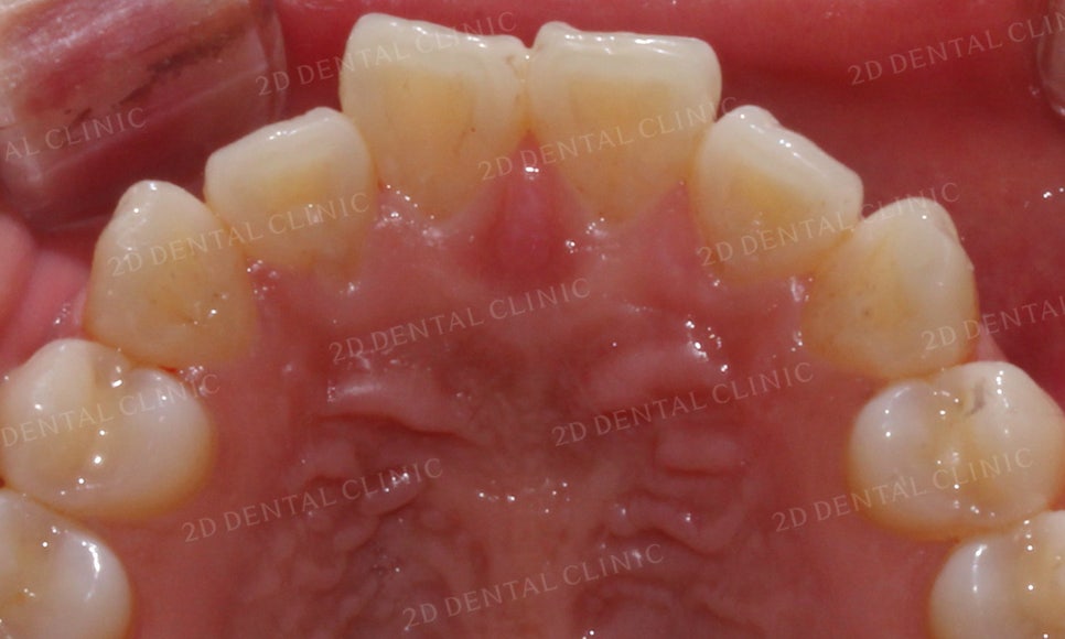 [2D교정] 나비치아, 앞니교정 설측교정으로 빠르게 하는 방법! by.2D치과(투디치과) 관련 이미지 15