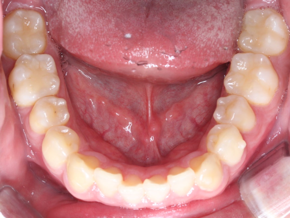 나비치아교정! 15개월만에 빠른 교정 by.투디치과(2D치과) 관련 이미지 6