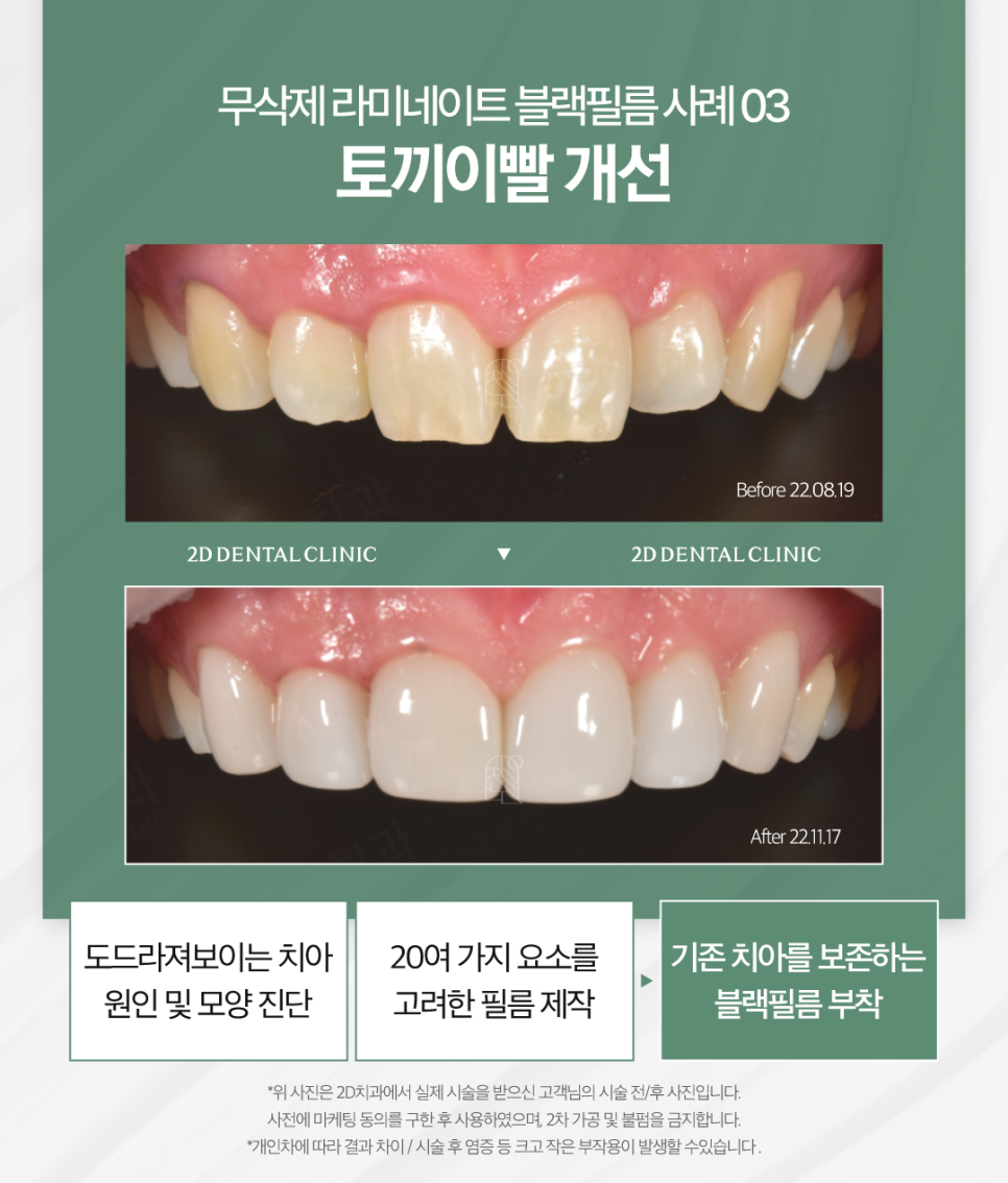 라미네이트하는이유 앞니심미치료 더욱 아름다운 치아로! 관련 이미지 6