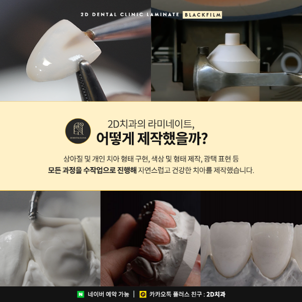 "깨진 앞니 방치하면 안 돼요!" 2D치과 맞춤 치료법 관련 이미지 5