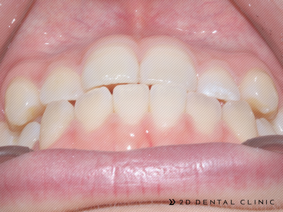 절단교합 교정 케이스 전후비교, 교정전문 2D치과 관련 이미지 5