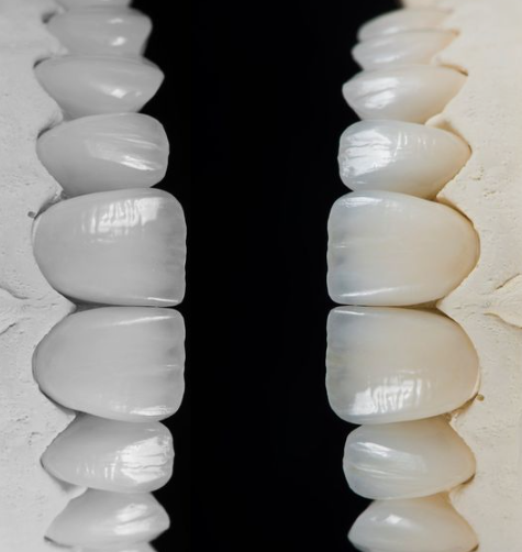 치아성형 잇몸성형 치아삭제 없는 무삭제라미네이트 블랙필름 관련 이미지 4