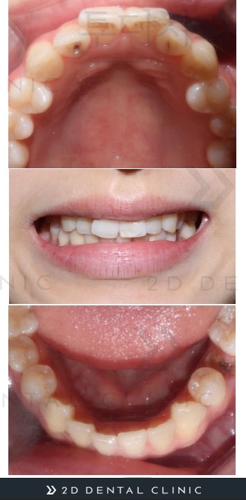 토끼이빨, 앞니 부분교정으로 단기간에! 강남 투디치과 관련 이미지 4