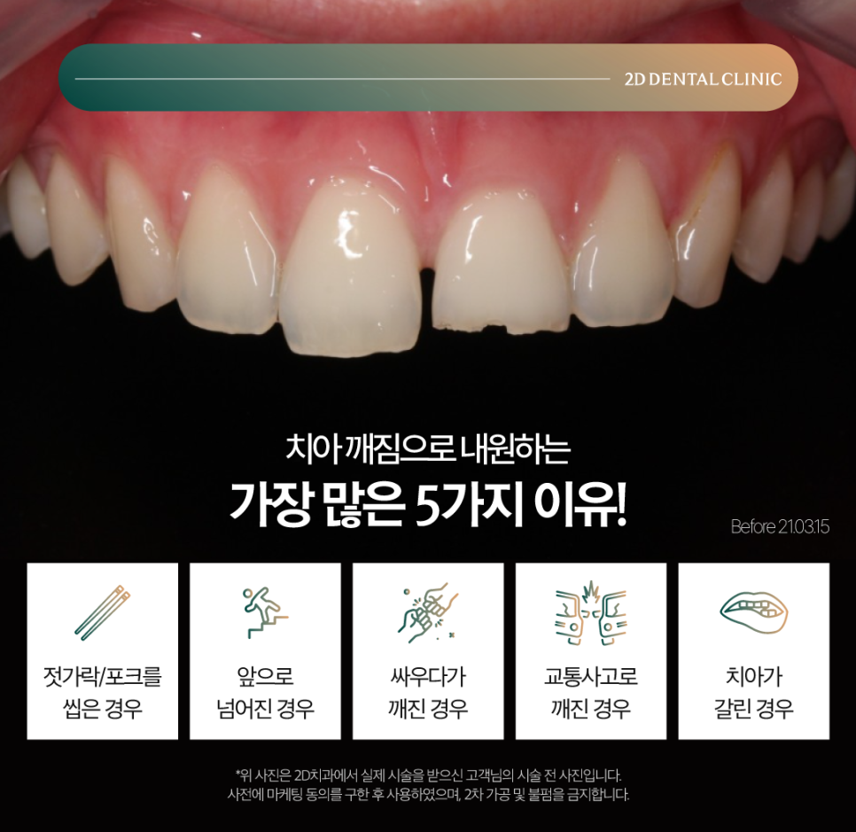 무삭제라미네이트비용 치아깨짐 파절된 앞니 보완하고 싶다면 관련 이미지 3