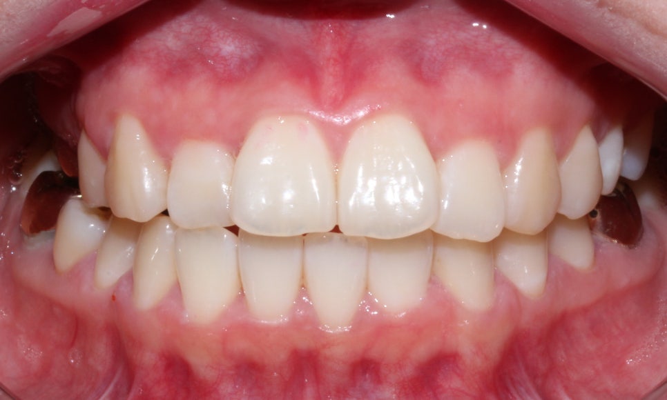 덧니 투명교정 8개월 치료 사례 관련 이미지 6